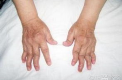 类风湿吃什么,营养搭配助力康复之路